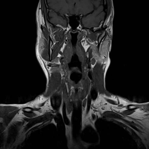 Снимок МРТ горла и гортани